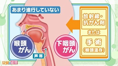 咽頭（いんとう）がん | 国立がん研究センター