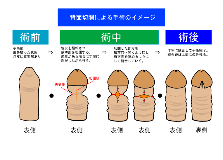 カントン包茎（嵌頓包茎）とは？手術と費用について｜MSクリニック