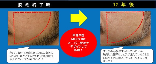 メンズTBCのヒゲ脱毛の口コミ・評判｜痛い・高いの悪いレビューは本当？体験談から徹底解説 | MOTEO