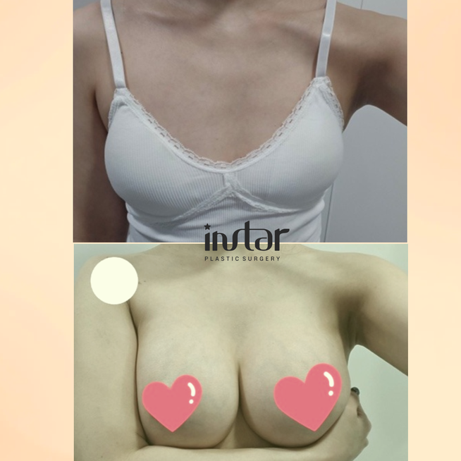 医学情報豊胸インプラント比較：モティバ、セビン、メンター、どれを選ぶ