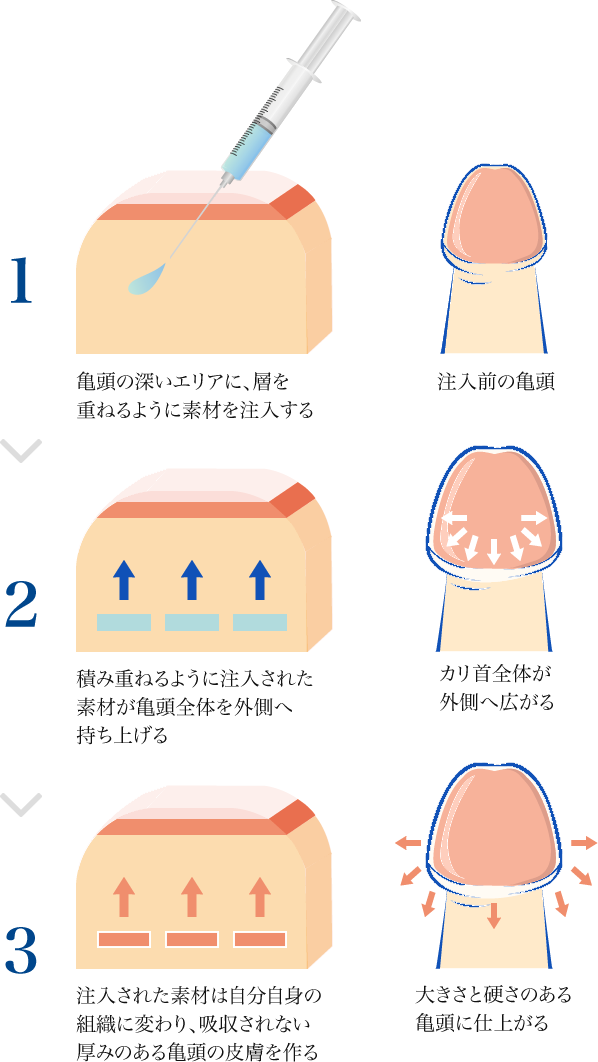 包茎で亀頭が敏感になりすぎて早漏になる理由と包茎治療や自力での改善方法を解説 | 包茎手術のノーストクリニック【公式】