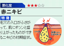 美容医療とエステの力でニキビ改善！ニキビメディカルコース｜ニキビのお悩みならお任せ！エステティックサロン【ラ・パルレ】公式