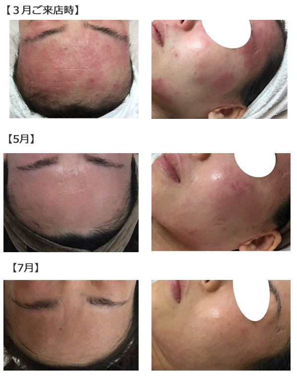 アトピー １０代 | 本気の肌質改善に最適な効果を実感できる施術です |