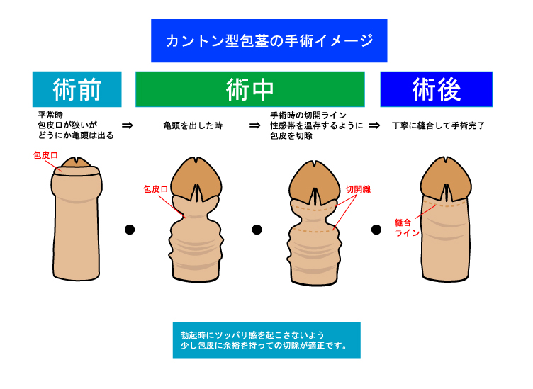 ペニスの悩み、いろいろ（思春期～大人編） - 紳也's ホームページ