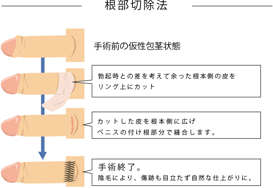 カントン包茎（嵌頓包茎）とは？手術と費用について｜MSクリニック