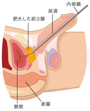 慢性前立腺炎｜神戸市東灘区 摂津本山｜いしむら腎泌尿器科クリニック