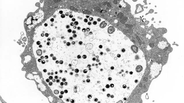 扁桃炎、のどの痛みの治療は足立区ひろい耳鼻咽喉科クリニックへ