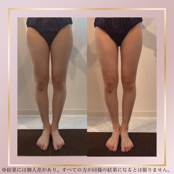 体験500円〜】京都で痩身エステが安いおすすめのサロン9選！通い放題のサロンも紹介 | Beauty