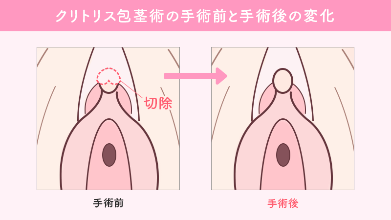 クリトリス包茎（陰核包茎）手術｜銀座の美容外科・皮膚科ならルーチェクリニック