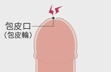 陰核（クリトリス）包茎術｜婦人科形成なら湘南美容クリニック【公式】