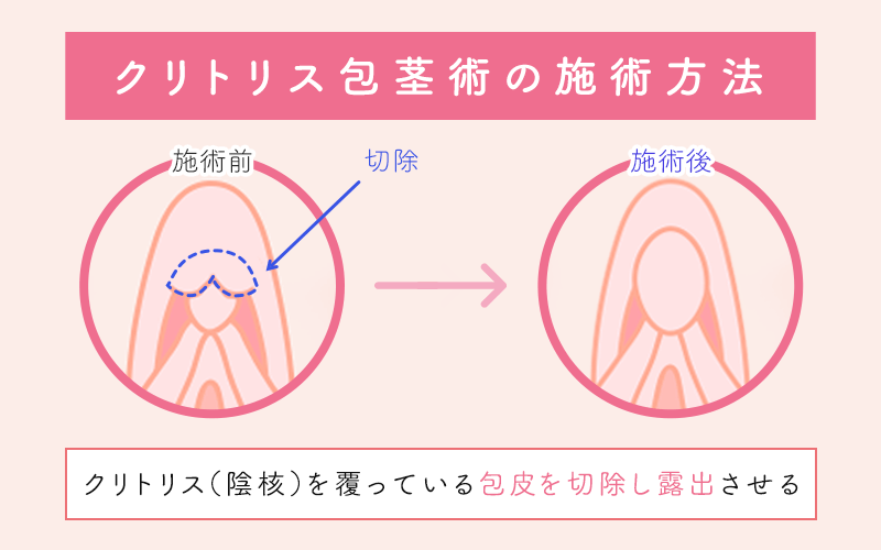 陰核の吸引器を自作する方法 | おっぱいが好き。