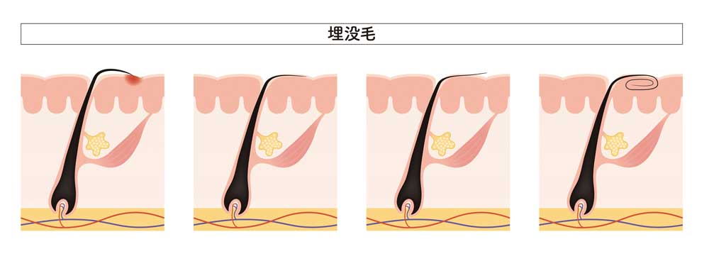 当方20代女性です。濃い毛を抜くのが好きです。特に男性のあごひげ。髭剃 - Yahoo!知恵袋