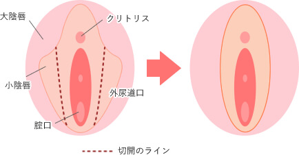 陰核（クリトリス）包茎手術｜大阪梅田【エースクリニック】HEPナビオ院