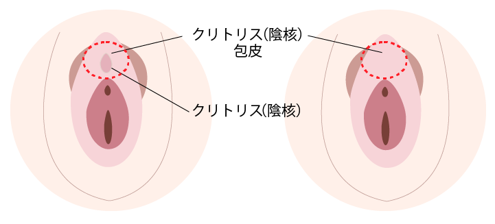 小陰唇縮小術｜びらびらを切除する婦人科形成｜新宿駅前婦人科クリニック【東京】