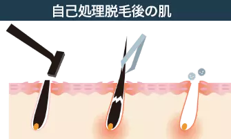 正しくケアして見た目が汚いヒゲの埋没毛を防ごう | メンズ脱毛百科事典