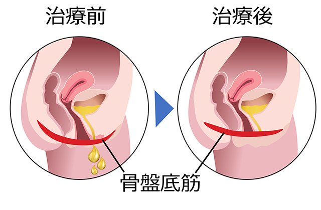 Emslim骨盤底筋産後筋肉トレーニング前立腺治療マッサージ椅子尿失禁バットリフトを￥375,818 | DHgate