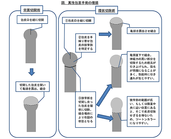 包茎手術を行った患者様からの声・体験談｜吉祥寺ビューティークリニックメンズ