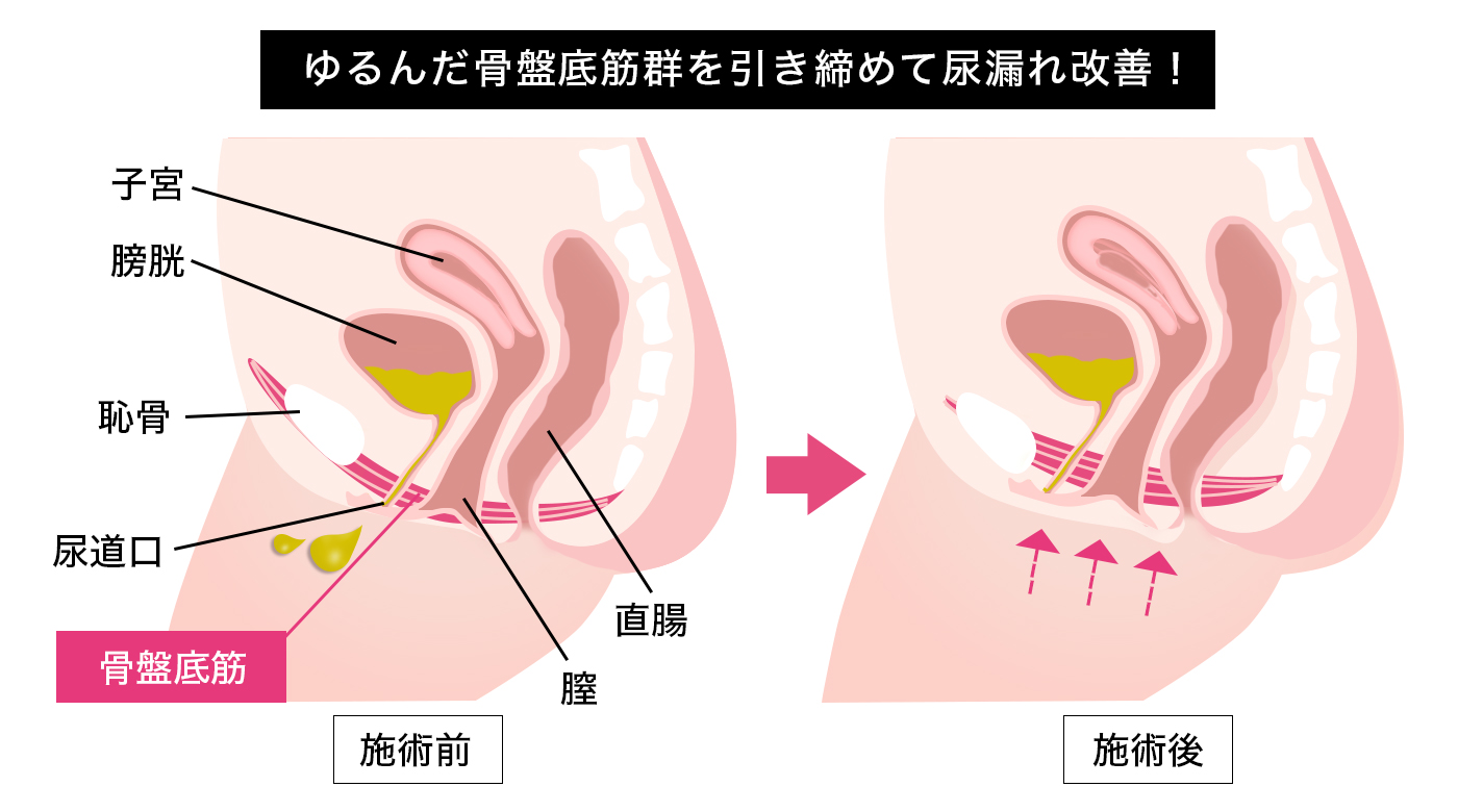 チンポに吸い付く膣穴にこじ開け生ファック！大人肉棒でチビマン拡張され無責任ザーメン注入