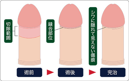 包茎手術 真性包茎 20代 モニター治療の詳細・臨床写真-東郷美容形成外科 福岡メンズ-福岡・博多・天神で包茎手術・治療