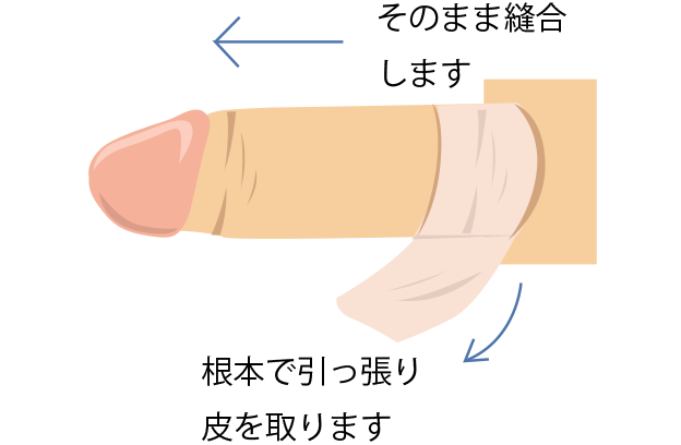 包茎がセックスに与える5つの影響！代表的な悩み＆注意点と治療法 - アトムクリニック - atom-clinic