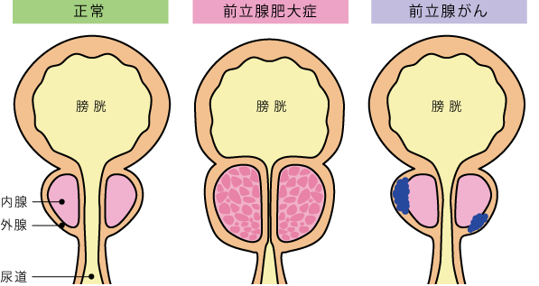 前立腺の治療器として開発された「アネロス」 | アネロスジャパン