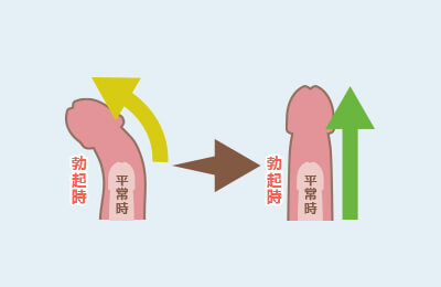 男性器に曲がりや痛み～中高年に多いペロニー病（東邦大学医療センター大森病院泌尿器科 三井要造講師）～｜医療ニュース  トピックス｜時事メディカル｜時事通信の医療ニュースサイト