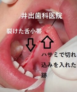 他院で受けた手術の修正（口もと・くちびる） ： 口もと・くちびる：美容外科 高須クリニック