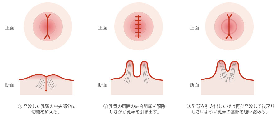 陥没乳頭(乳管を温存しつつ、乳首を出したい) :: 酒井形成外科 美容外科