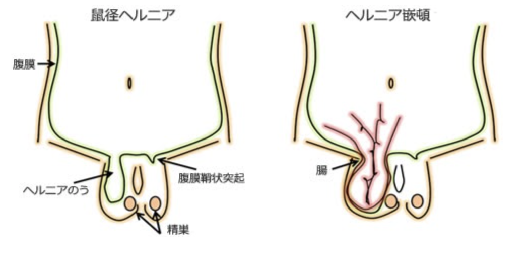 ヘルニア疾患：昭和大学横浜市北部病院 外科系診療センター 外科