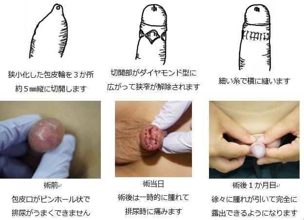 むけない包茎を自分で改善できる方法「むきトレ」とは？ | ネオ形成外科