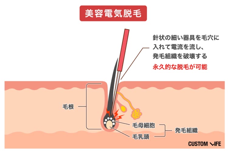 メンズTBCの髭・VIO・全身脱毛の効果を徹底分析！ | メンズ脱毛の比較・分析・診断サイト | リコメン