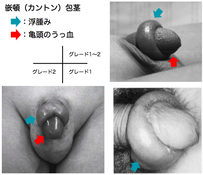 有楽町美容外科クリニック：包茎治療＋亀頭増大術セット