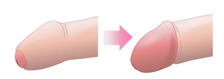 包茎の手術が必要なケースと理由 ｜ 京都駅前院 いちおか泌尿器科クリニック