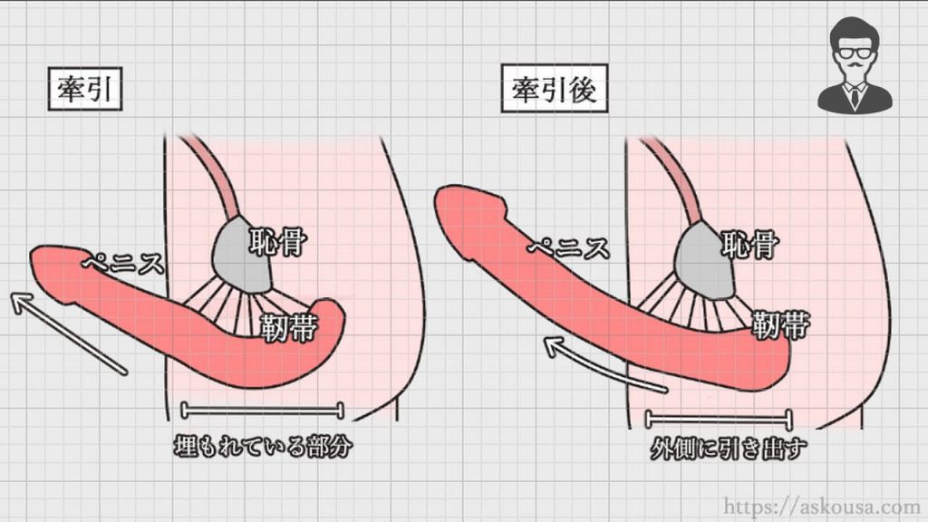 長茎術・切らない長茎術｜MSクリニック