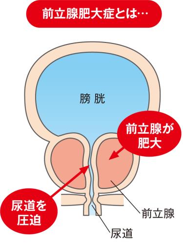 尿漏れ予防 | 健康長寿ネット